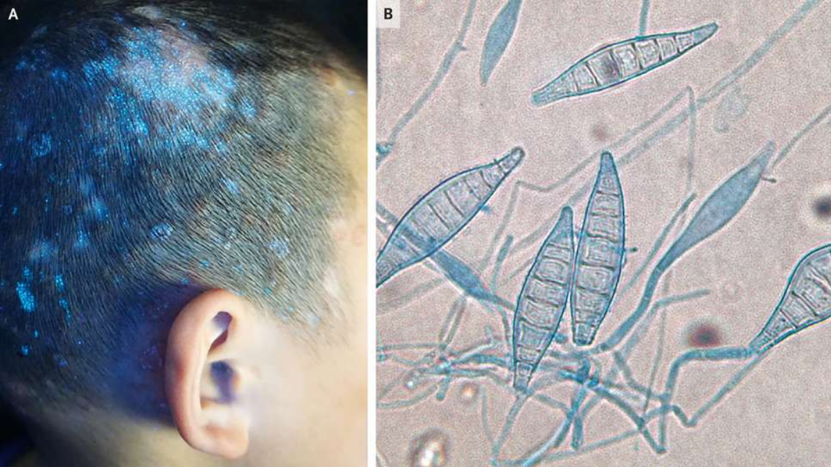 على اليسار تظهر البثور الزرقاء على فروة رأس الطفل وعلى اليمين الفطريات الميكروسكوبية المسؤولة عن حالته. © تينجتينج وانج وآخرون. NEJM